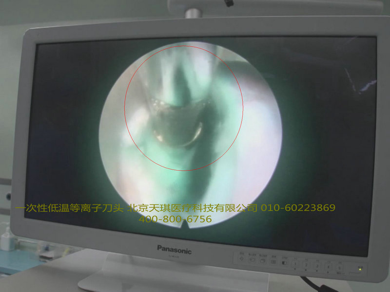 一次性使用等離子刀頭價格，低溫等離子刀頭，雙極射頻手術刀頭，等離子刀頭